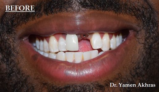 Dr. Akhras' patient with missing front tooth before implant crown
